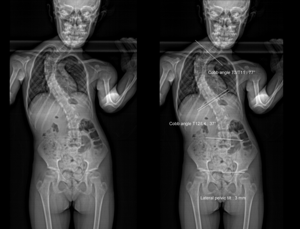 Scoliosis Dataset