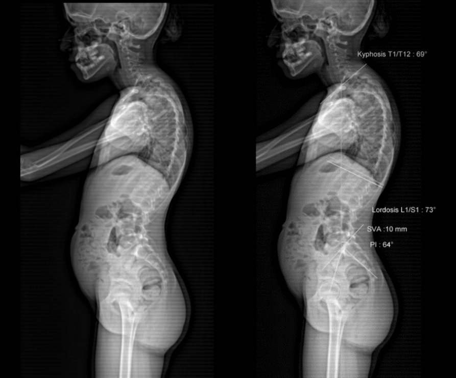 Kyphosis Dataset