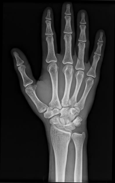 Carpal Fractures Dataset